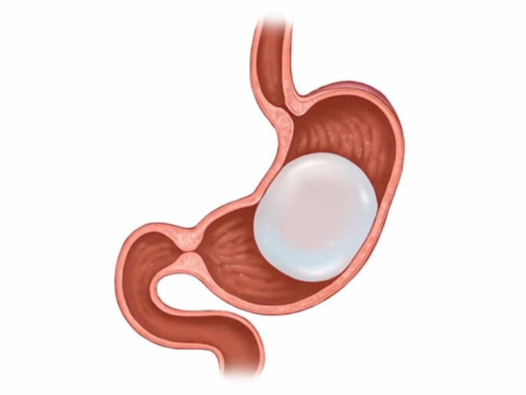 Gastric Balloon in Turkey