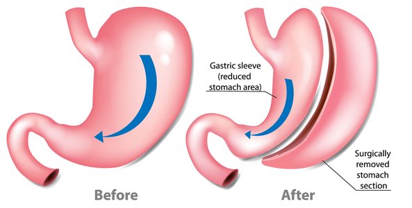 Gastric Sleeve surgery in Turkey