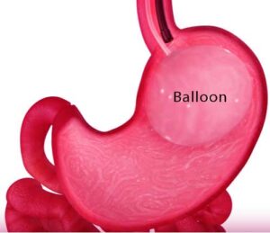 Gastric balloon placement