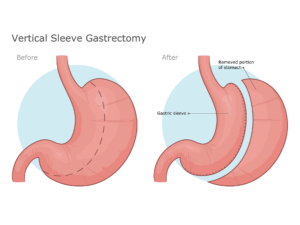 Gastric sleeve surgery