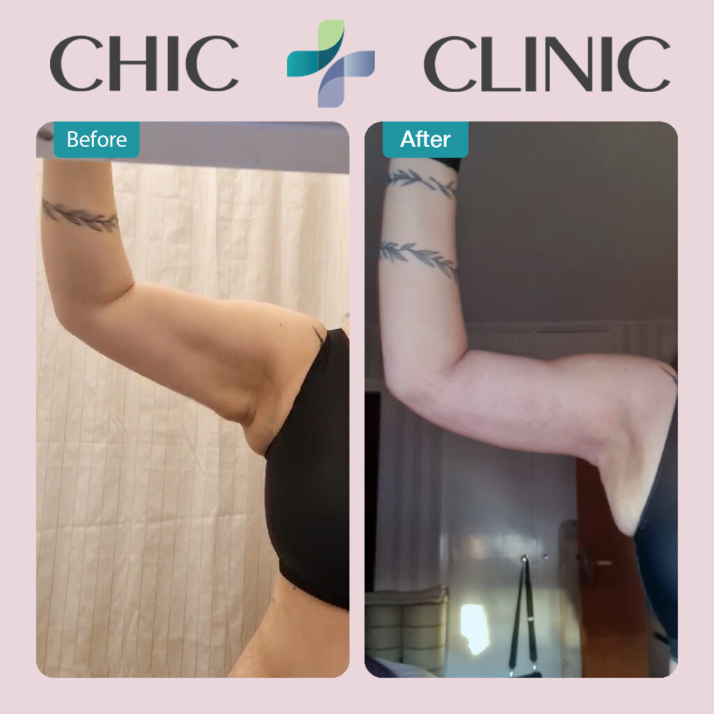 Arm Lift surgery before and after