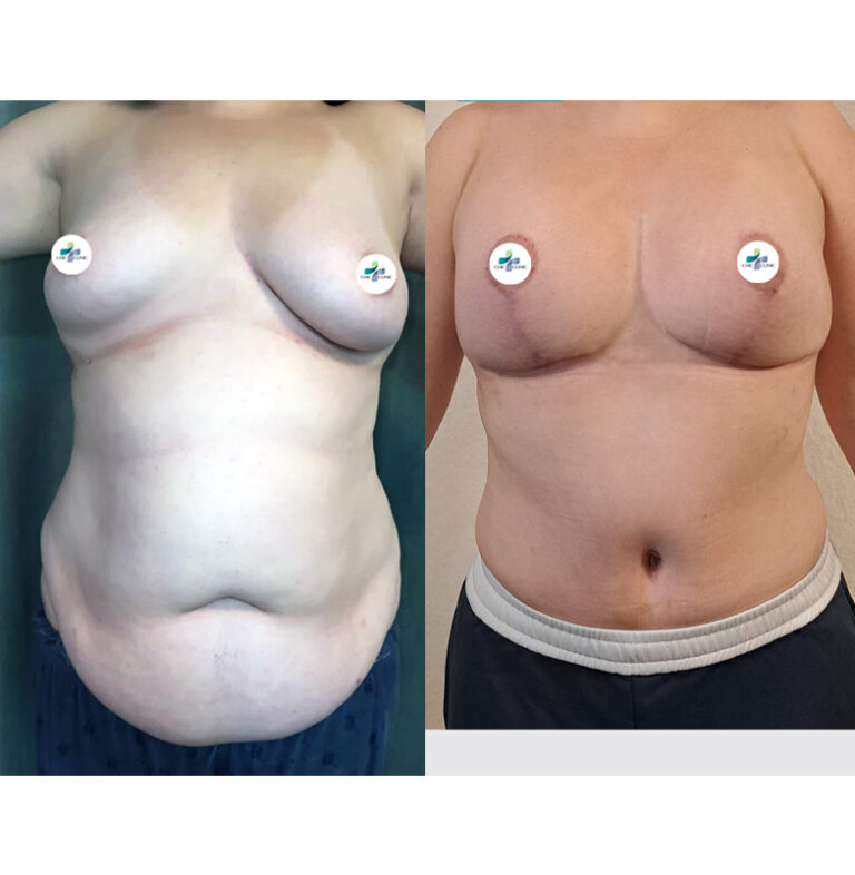 Abdominoplasty