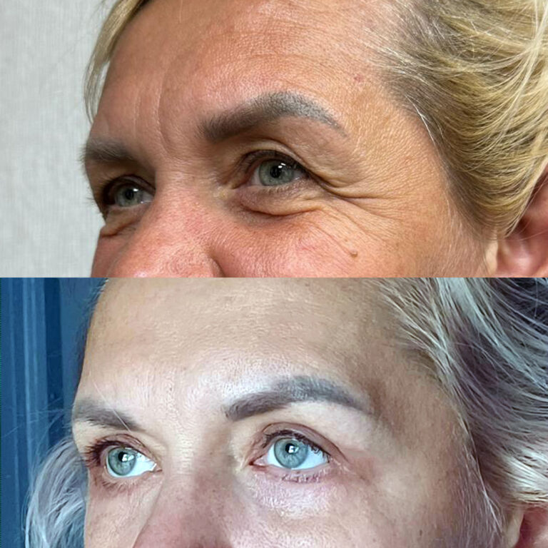 Blepharoplasty