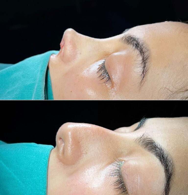 Nose job