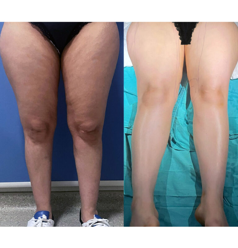 Thigh Lipo