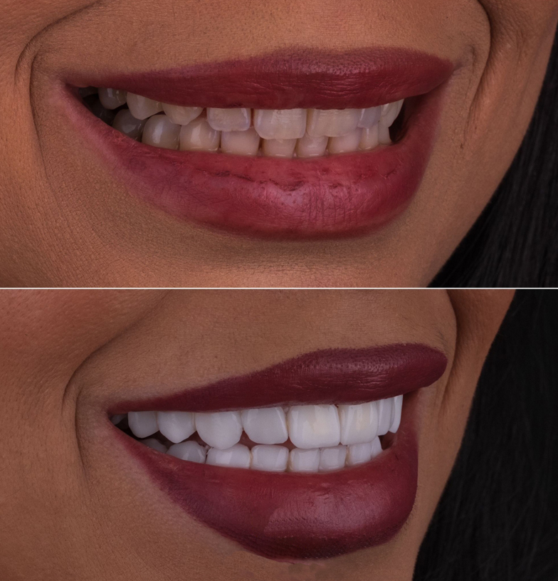 Sorriso hollywoodiano