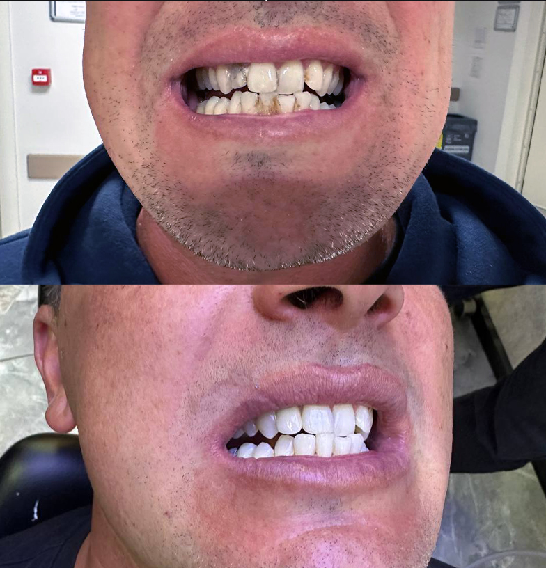 blanqueamiento de dientes