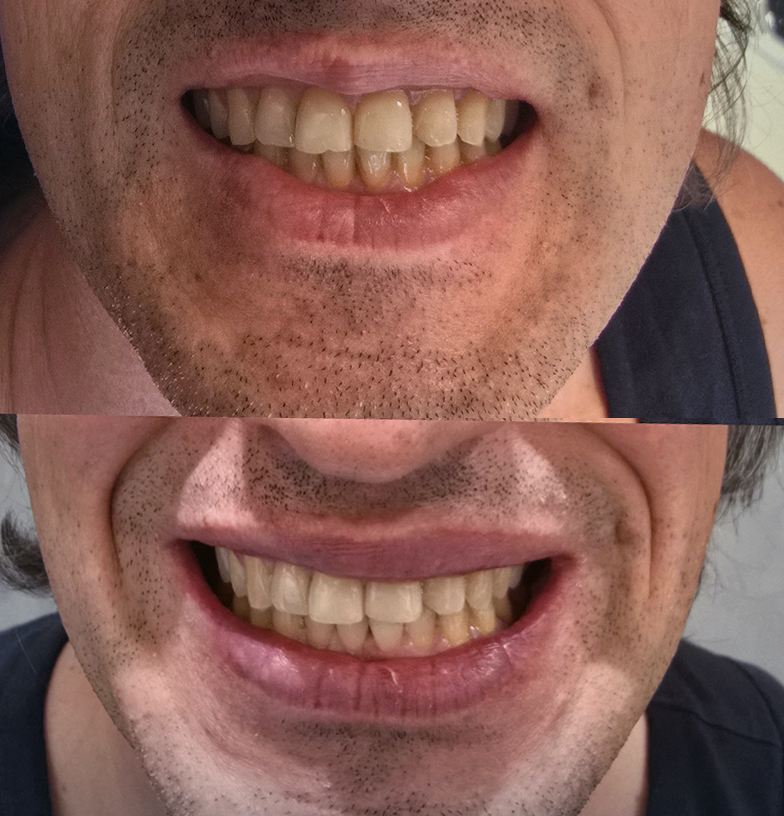 Teeth whitening