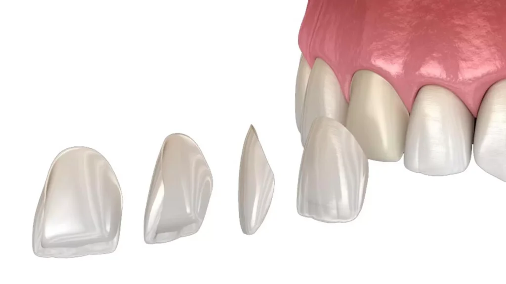 Emax Veneer