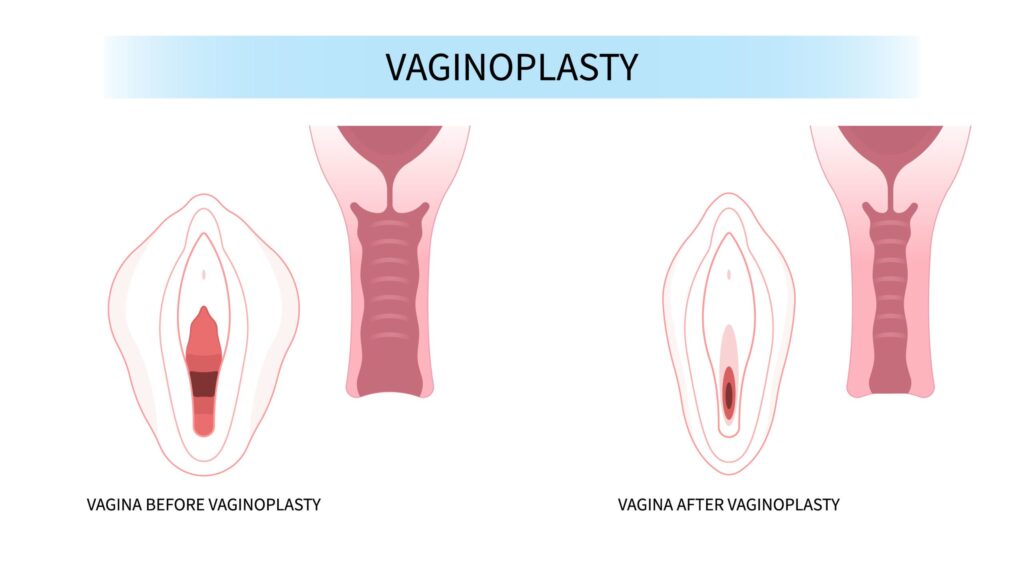 Vaginaplasty