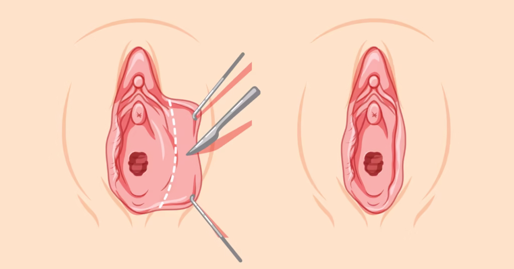 Labiaplasty