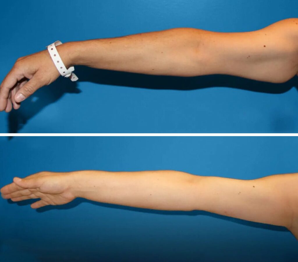 Lifting de braços em Istanbul na Chic Clinic Istanbul