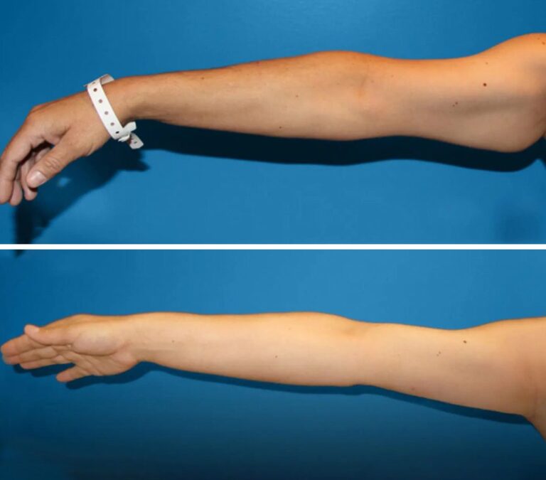 Lifting de braços em Istanbul na Chic Clinic Istanbul